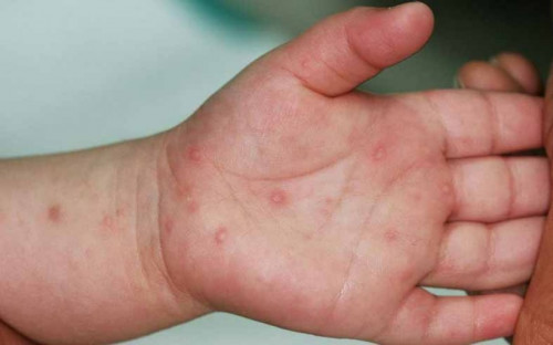 Hà Nội: Dịch tay chân miệng gia tăng, dịch sởi chưa giảm nhiệt