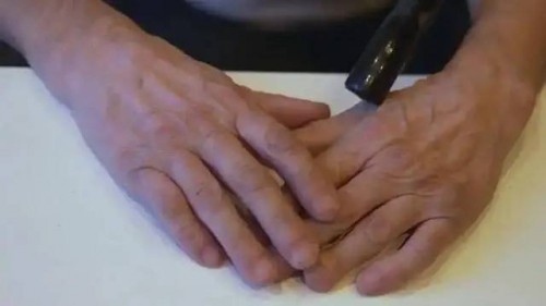 Dấu hiệu ung thư phổi