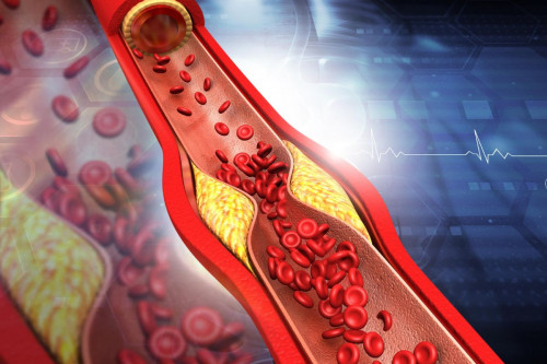 Triệu chứng trên giường có thể báo hiệu cholesterol cao.