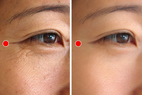 Sản phẩm xóa nếp nhăn