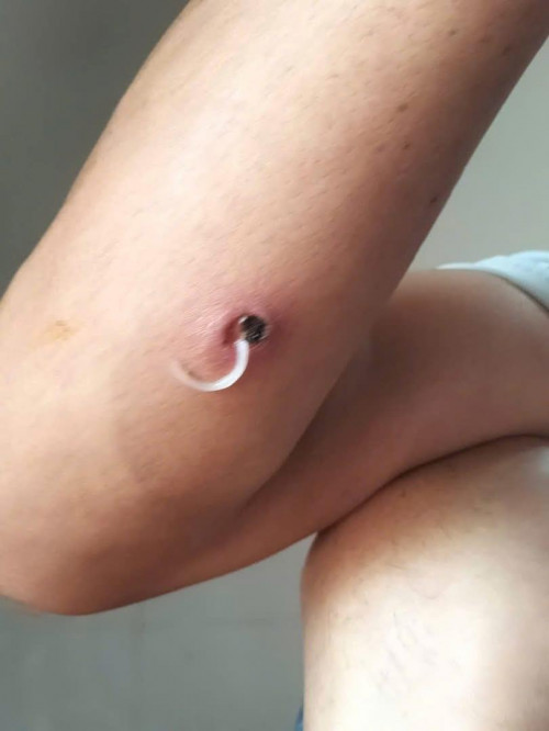 Cảnh báo bệnh giun rồng xuất hiện tại một tỉnh ở Việt Nam- Ảnh 1.