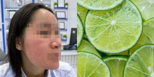 Dùng nước chanh trị mụn theo trên mạng, cô gái trẻ "hỏng mặt"- Ảnh 1.