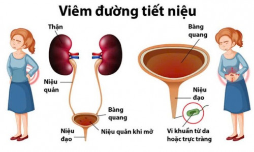 Triệu chứng NTTN