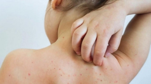Một ca rubella vừa phát hiện
