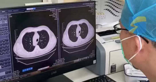 Cảm lạnh và ho, phổi trái của nam sinh đột nhiên "biến mất": Bác sĩ tiết lộ nguyên nhân nhiều người phải cẩn thận- Ảnh 1.