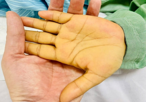5 dấu hiệu nhận biết sớm ung thư gan