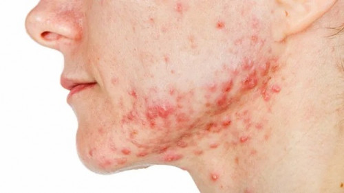 Sắp có vắc xin ngừa mụn trứng cá