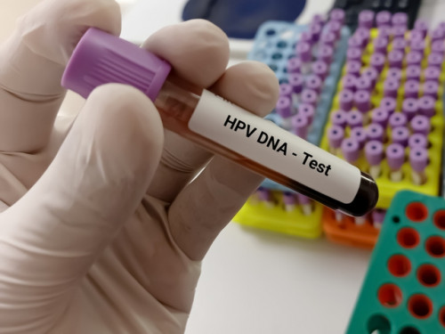 Có cần xét nghiệm virus HPV trước khi tiêm vắc xin HPV không?- Ảnh 1.
