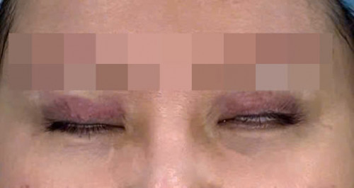 Cắt mí ở spa hồng dẫn tới mặt tròn, lộ đồ, không nhắm khít được cả khi ngủ