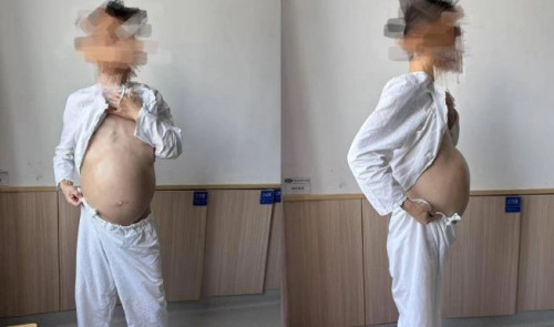 Người đàn ông 40 tuổi bụng to như mang bầu, khi phẫu thuật bác sĩ phát hiện điều đáng sợ.