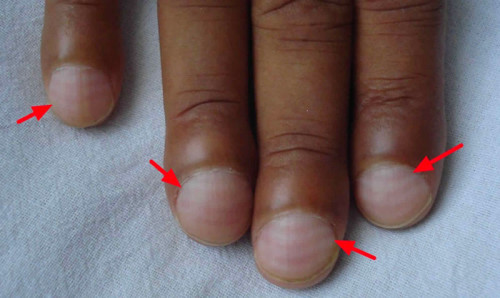Dấu hiệu cảnh báo bệnh phổi