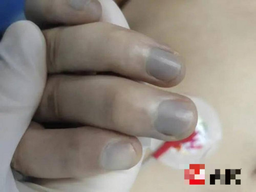 Móng tay bà Triều chuyển sang màu xanh tím.