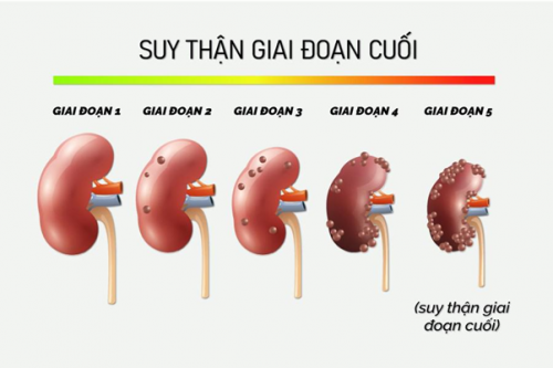 Diễn viên Ngân Hoa bị suy thận giai đoạn cuối ở tuổi 29: Phương pháp điều trị là gì?- Ảnh 3.