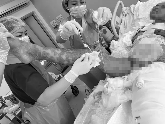 Bệnh nhân bị lột da toàn thân sau khi sử dụng kháng sinh- Ảnh 2.