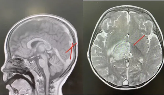 Bé trai hơn 2 tuổi đột quỵ vì bệnh lý hiếm gặp