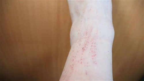 Ăn đậu luộc trong 20 năm, người phụ nữ bị loét da- Ảnh 1.