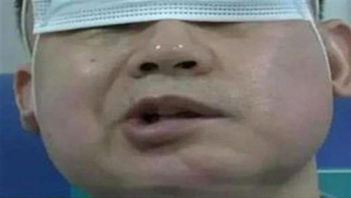 Bắt điều hòa ngũ cho mắt, người đàn ông bị liệt mặt, bác sĩ cảnh báo thói quen yêu thích của người trẻ - Ảnh 1.