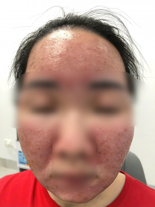 Nữ sinh Hà Nội "cháy da" vì tin lời quảng cáo kem chống nắng giá rẻ trên mạng- Ảnh 1.