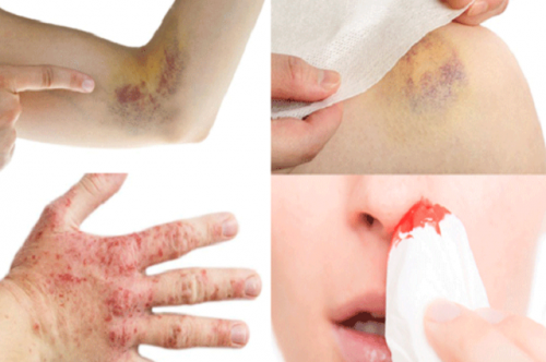 Cô gái 23 tuổi mắc ung thư máu
