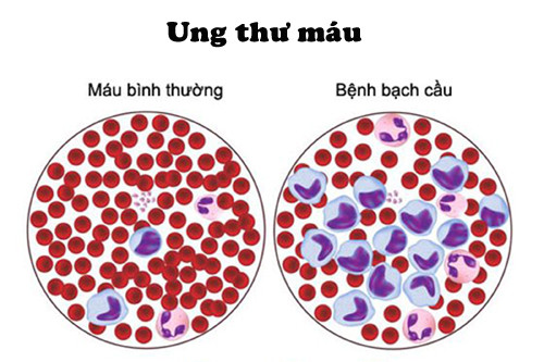 Cô gái 23 tuổi mắc ung thư máu