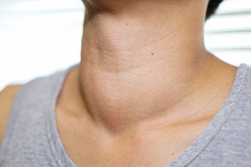 Sao phim "The Boys" tiết lộ mắc bệnh cường giáp khiến người hâm mộ lo lắng