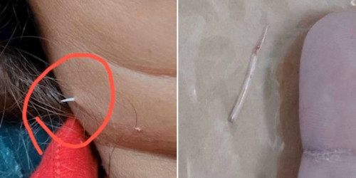 Người phụ nữ bị xương cá đâm xuyên qua da.