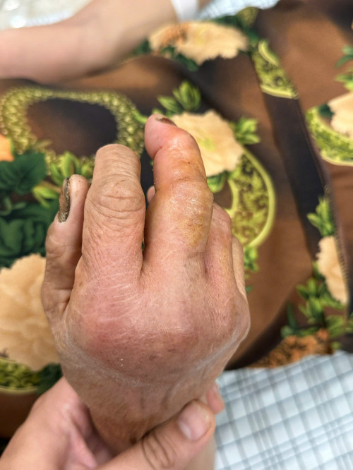 Người phụ nữ bị rắn hổ mang cắn vào tay