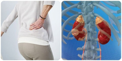 Triệu chứng ung thư thận giai đoạn cuối - Ảnh 1.