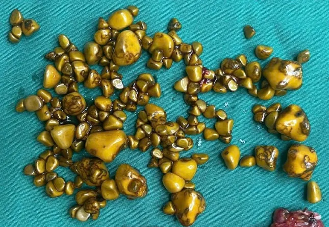 Viên sỏi trong túi mật của bệnh nhân