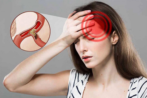 Những lưu ý về nguy cơ nhồi máu não: Cảnh giác với các triệu chứng để phát hiện sớm