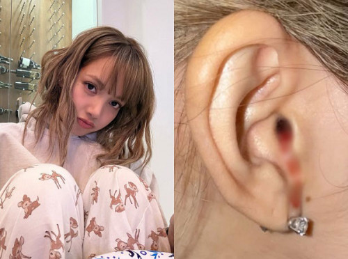 Tai Lisa chảy máu