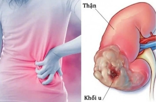 Dấu hiệu âm thầm của ung thư thận dễ bị bỏ qua - Ảnh 1.