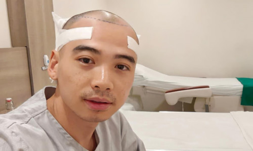 Chồng H'Hen Niê thay đổi thế nào sau cây tóc trị hói đầu? Phương pháp này có giá bao nhiêu?- Ảnh 3.