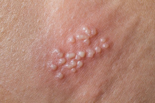Mụn cóc sinh dục là gì?