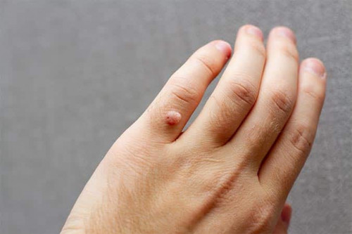 Mụn cóc thông thường