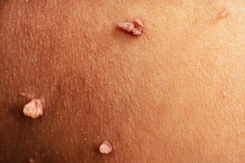 Mụn cóc sinh dục
