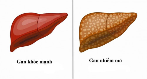 Bé trai 9 tuổi đã bị xơ gan, bác sĩ khuyến cáo thay đổi 1 điều trong ăn uống nhưng cha mẹ bỏ qua khiến bệnh càng nặng