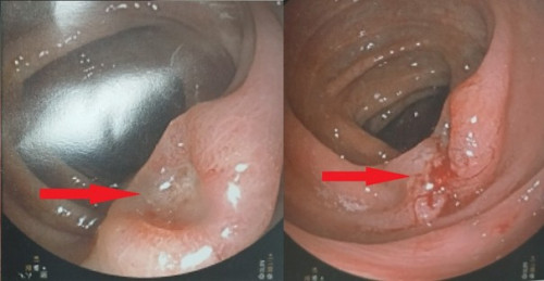 Đại tràng có ổ loét trước và sau sinh thiết.