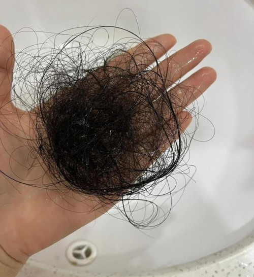 Bệnh rụng tóc - Ảnh 2