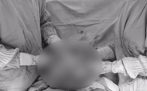 U xơ tử cung khổng lồ 7kg: Ca phẫu thuật căng thẳng kéo dài 6 giờ- Ảnh 1.
