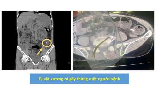 Hình ảnh dị vật được lấy ra trong phẫu thuật