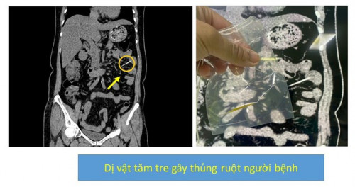Hình ảnh dị vật trong ruột bệnh nhân