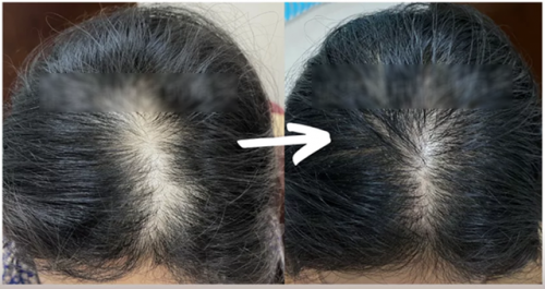 Cô gái 29 tuổi tóc đã rụng hói đầu, bác sĩ: Nguyên nhân rụng tóc, kích thích mọc tóc cần tránh xa những thứ này