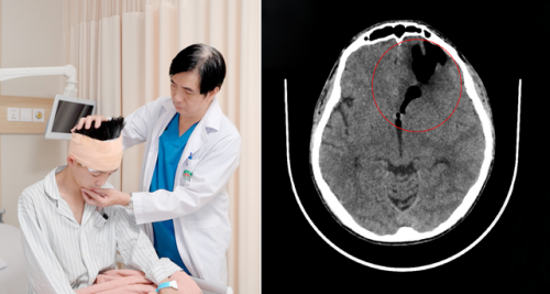 Đau đầu, chảy nước mũi, nam thanh niên phát hiện bị rò dịch não tủy - Ảnh 1.