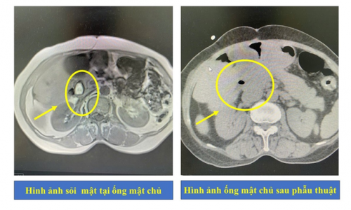 Bệnh nhân bị sỏi mặt và giun 15cm trong đường mật - Ảnh 2.