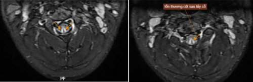 Hình ảnh MRI của bệnh nhân phát hiện tổn thương sau tủy cổ