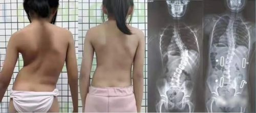 Cột sống của nữ sinh 16 tuổi cong gấp 45 độ! Bác sĩ: Chỉ 20 trẻ thì có 1 trẻ bị - Ảnh 1.