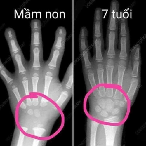 Tràn lan thông tin 'trẻ mầm non tập viết sớm hại cho sự phát triển xương'