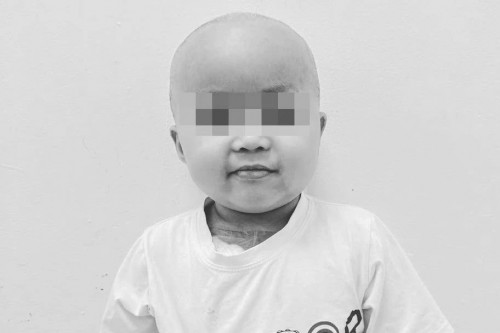 Bé Bắp sau thời gian điều trị