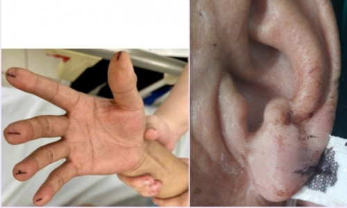 Chích máu đầu ngón tay cứu đột quỵ: Cứu người hay rước họa? – Ảnh 2.